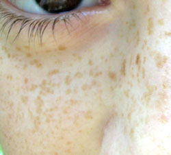Freckles are epigenetic, meaning sunlight exposure can trigger them. Image by Loyna.