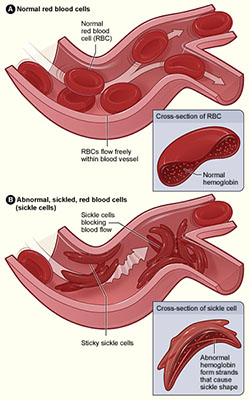 Sickle cells. Click for more detail.