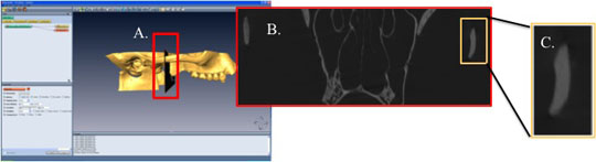 Virtual analysis of bone morphology.