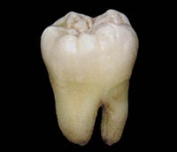 Wisdom tooth